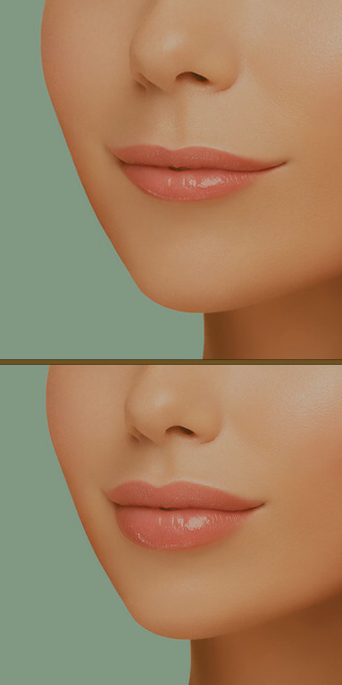 Clínica de Preenchimento Labial na Vila Clementino